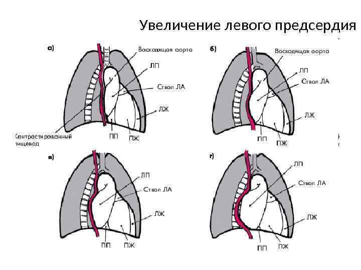 Увеличение левого предсердия 