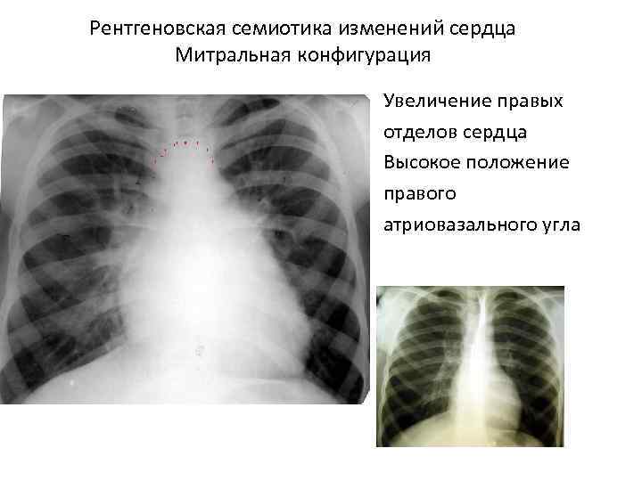 Рентгеновская семиотика изменений сердца Митральная конфигурация Увеличение правых отделов сердца Высокое положение правого атриовазального