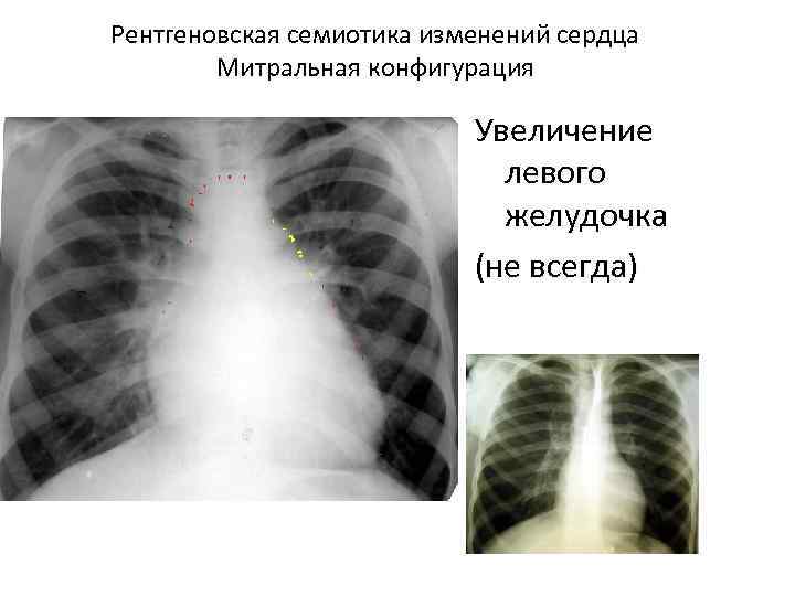 Рентгеновская семиотика изменений сердца Митральная конфигурация Увеличение левого желудочка (не всегда) 