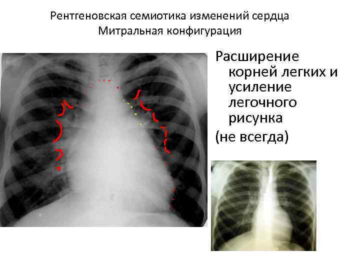 Легочный рисунок в базальных отделах. Усиление легочного рисунка. Усиление рисунка легких что это. Усиление сосудистого рисунка легких. Усил ение логочного рисунка.