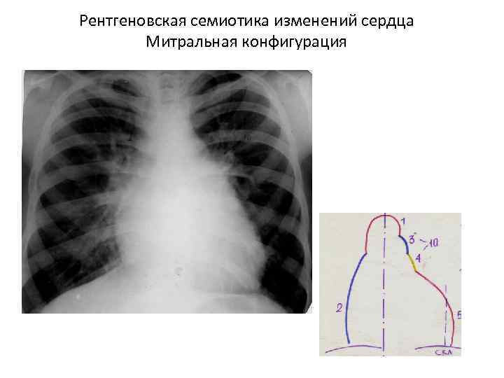 Рентгеновская семиотика изменений сердца Митральная конфигурация 