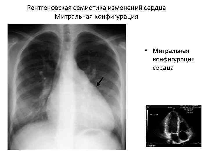 Рентгеновская семиотика изменений сердца Митральная конфигурация • Митральная конфигурация сердца 