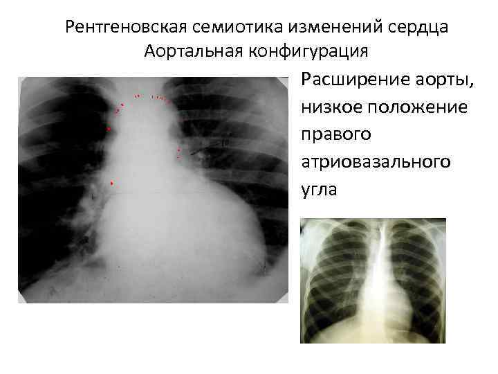 Рентгеновская семиотика изменений сердца Аортальная конфигурация Расширение аорты, низкое положение правого атриовазального угла 