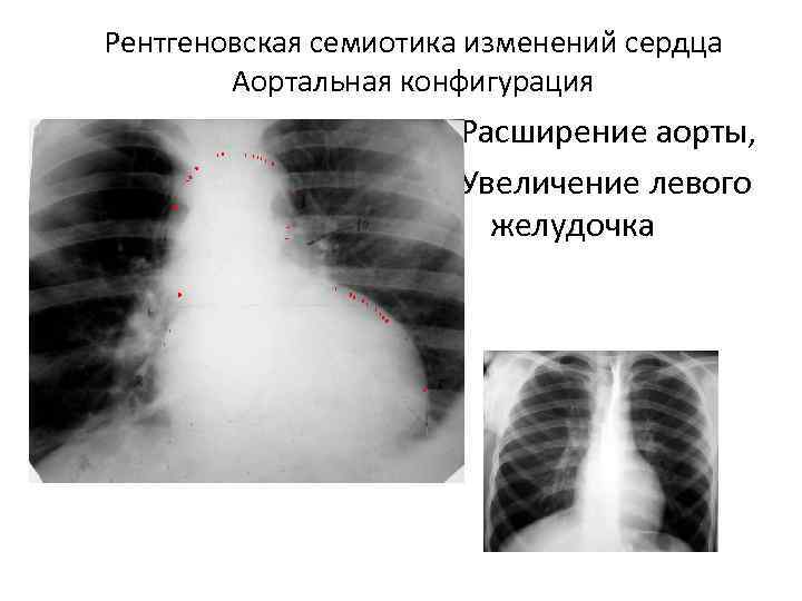 Рентгеновская семиотика изменений сердца Аортальная конфигурация Расширение аорты, Увеличение левого желудочка 