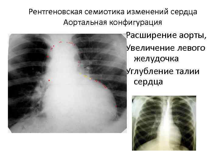 Рентгеновская семиотика изменений сердца Аортальная конфигурация Расширение аорты, Увеличение левого желудочка Углубление талии сердца