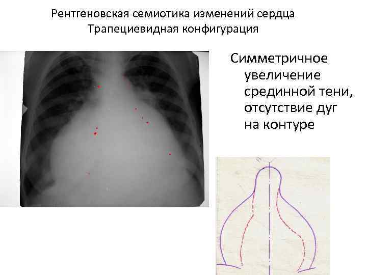 Рентгеновская семиотика изменений сердца Трапециевидная конфигурация Симметричное увеличение срединной тени, отсутствие дуг на контуре