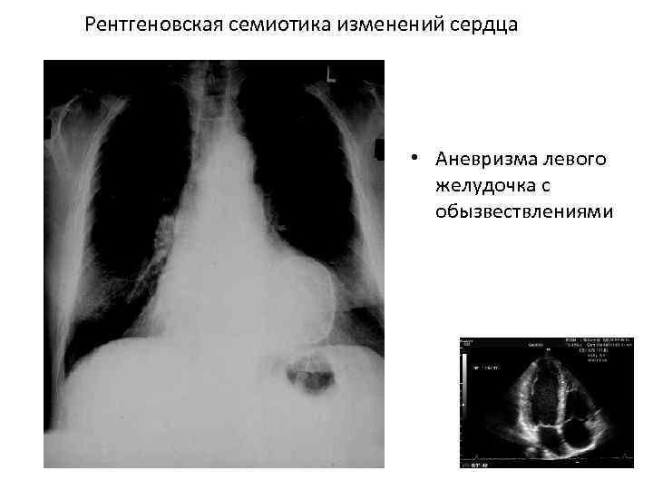 Рентгеновская семиотика изменений сердца • Аневризма левого желудочка с обызвествлениями 