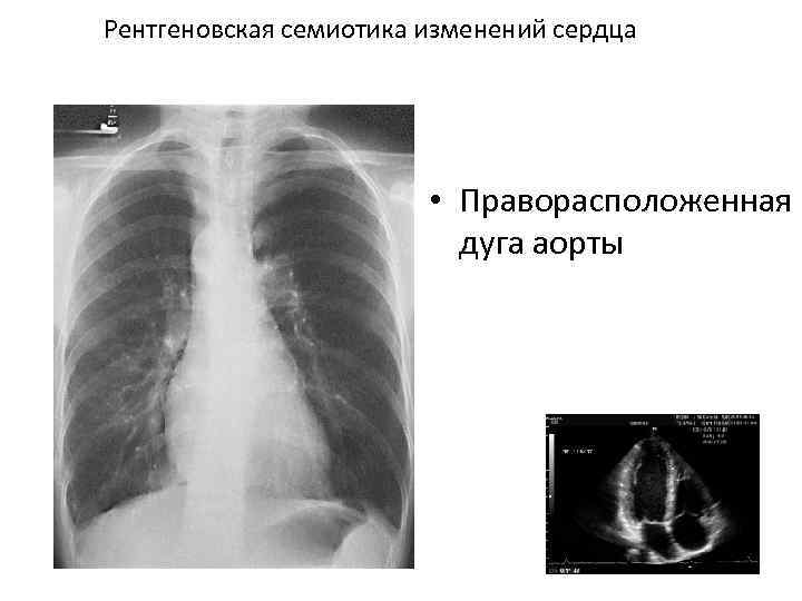 Рентгеновская семиотика изменений сердца • Праворасположенная дуга аорты 