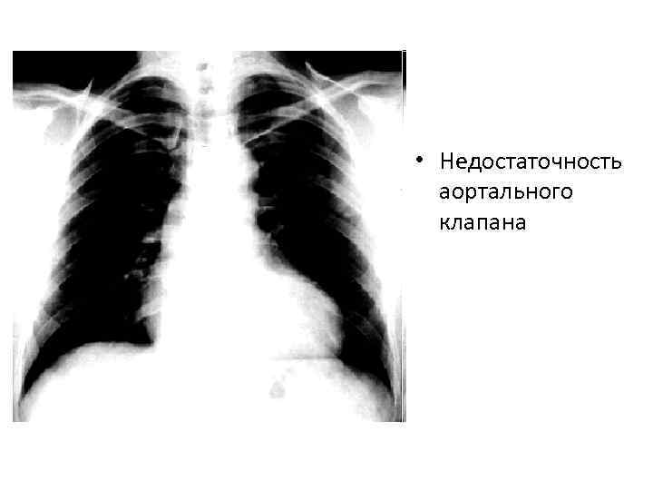  • Недостаточность аортального клапана 