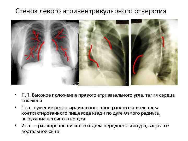 Стеноз левого атривентрикулярного отверстия • П. П. Высокое положение правого атривазального угла, талия сердца