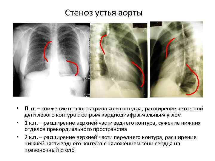 Стеноз устья аорты • П. п. – снижение правого атривазального угла, расширение четвертой дуги