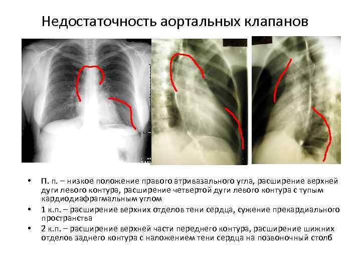 Недостаточность аортальных клапанов • • • П. п. – низкое положение правого атривазального угла,