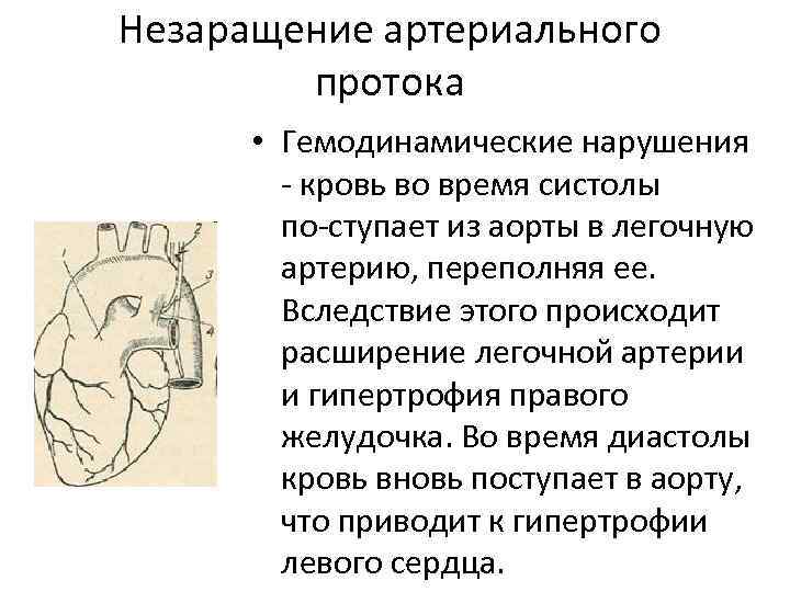 Незаращение артериального протока • Гемодинамические нарушения кровь во время систолы по ступает из аорты