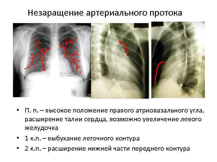 Незаращение артериального протока • П. п. – высокое положение правого атриовазального угла, расширение талии