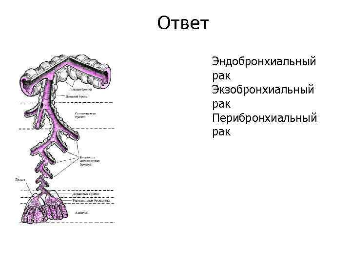 Ответ Эндобронхиальный рак Экзобронхиальный рак Перибронхиальный рак 