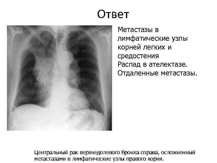 Лимфоузлы при раке легкого