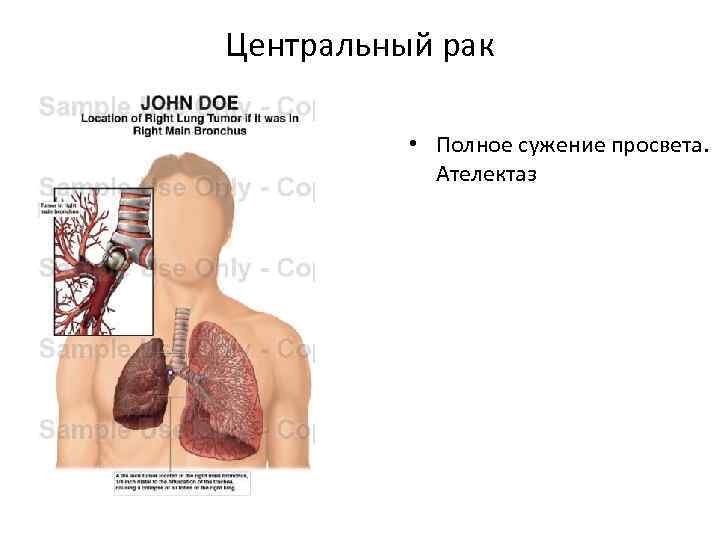 Центральный рак • Полное сужение просвета. Ателектаз 