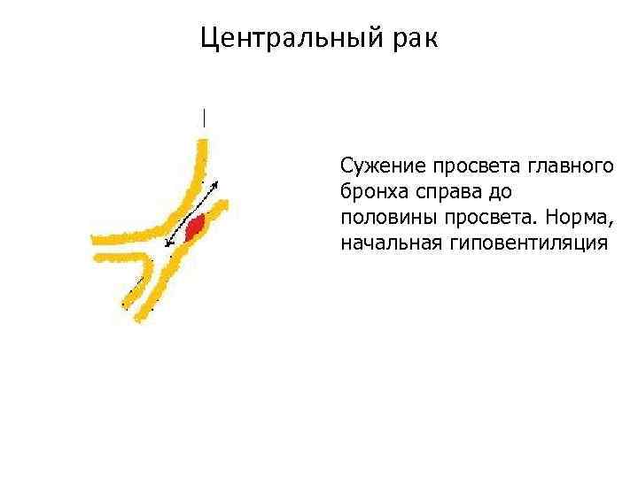 Центральный рак Сужение просвета главного бронха справа до половины просвета. Норма, начальная гиповентиляция 