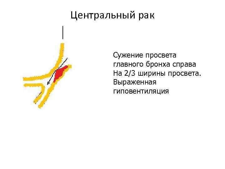 Центральный рак Сужение просвета главного бронха справа На 2/3 ширины просвета. Выраженная гиповентиляция 