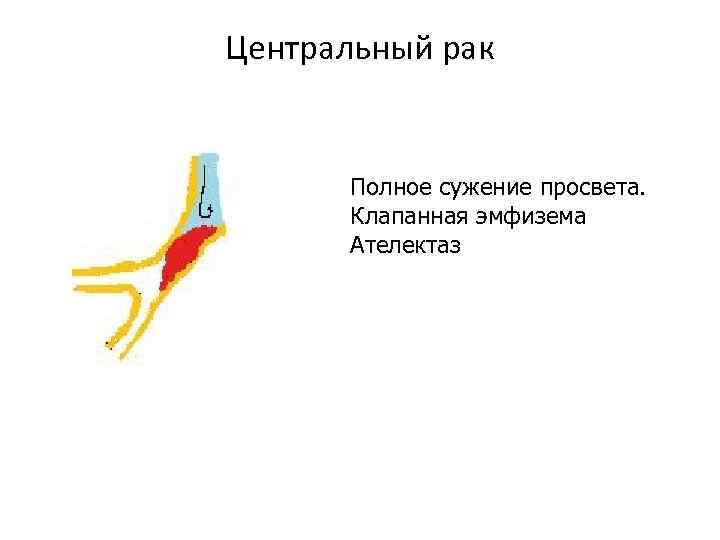 Центральный рак Полное сужение просвета. Клапанная эмфизема Ателектаз 