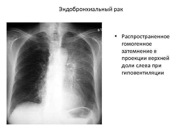 Эндобронхиальный рак • Распространенное гомогенное затемнение в проекции верхней доли слева при гиповентиляции 