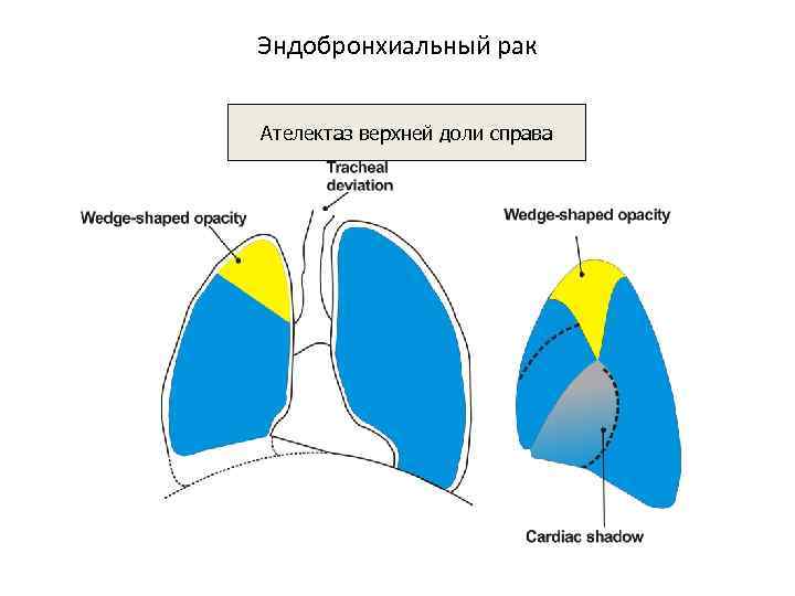 Эндобронхиальный рак Ателектаз верхней доли справа 