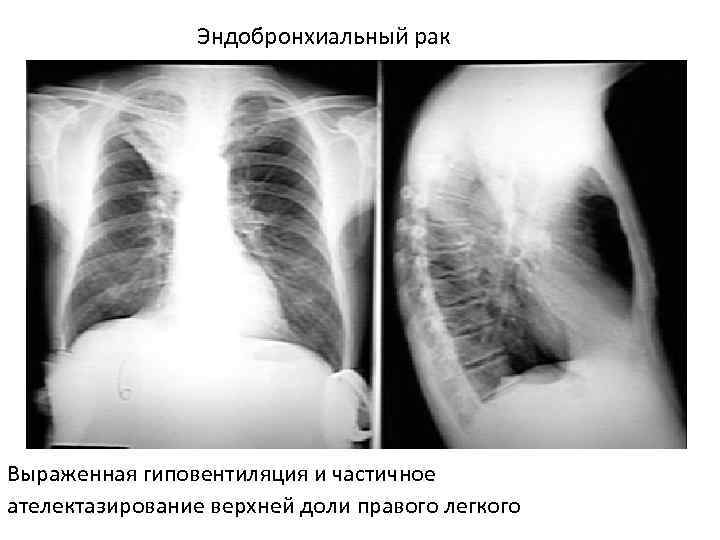 Центральный рак правого. Гиповентиляция верхней доли правого легкого. Эндобронхиальная опухоль на рентгене. Гиповентиляция верхней доли рентген. Гиповентиляция верхней доли рентгенограмма.