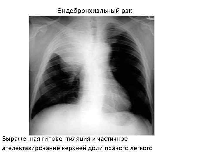 Рак правого. Гиповентиляция верхней доли правого легкого. Гиповентиляция верхней доли рентгенограмма. Гиповентиляция верхней доли рентген. Гиповентиляция верхней доли легких рентген.