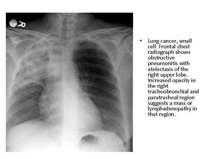  • Lung cancer, small cell. Frontal chest radiograph shows obstructive pneumonitis with atelectasis