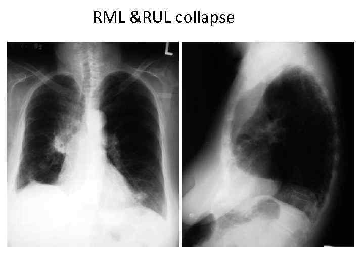 RML &RUL collapse 