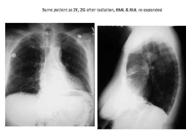 Same patient as 2 F, 2 G after radiation, RML & RUL re-expanded 