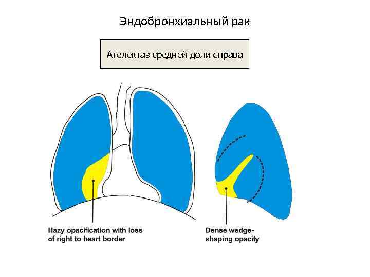 Ателектаз легкого среднего