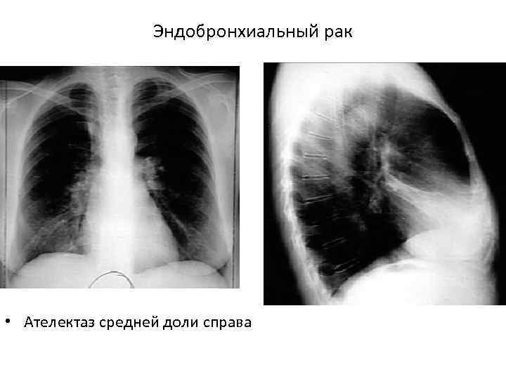 Ателектаз легкого на рентгеновском снимке фото