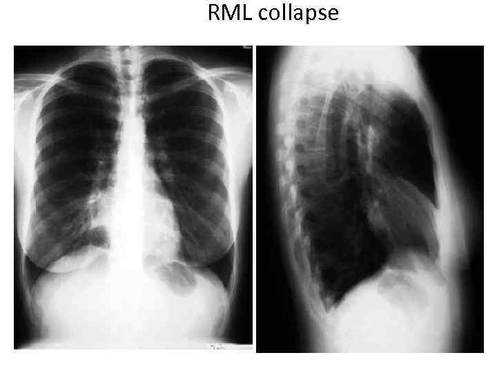 RML collapse 