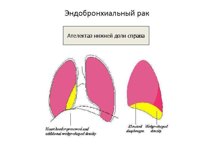 Эндобронхиальный рак Ателектаз нижней доли справа 