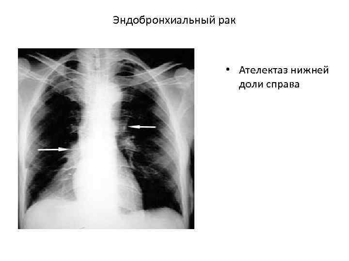 Эндобронхиальный рак • Ателектаз нижней доли справа 