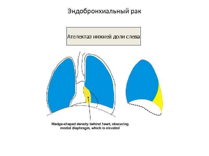 Ателектаз левой доли легкого