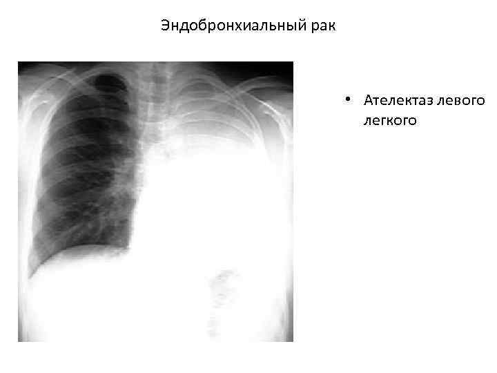 Эндобронхиальный рак • Ателектаз левого легкого 