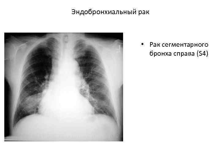 Эндобронхиальный рак • Рак сегментарного бронха справа (S 4) 