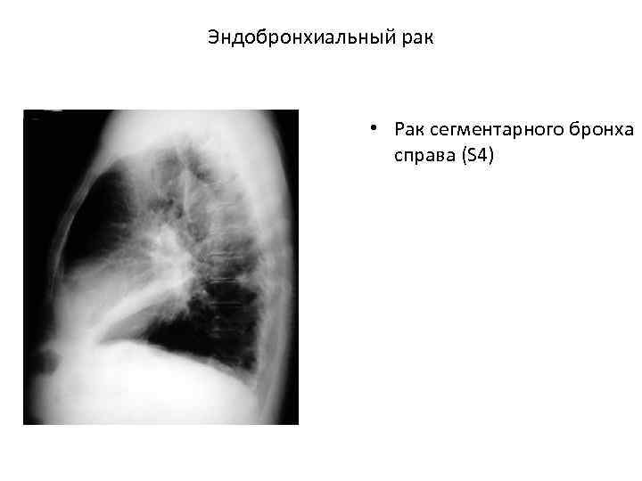 Эндобронхиальный рак • Рак сегментарного бронха справа (S 4) 