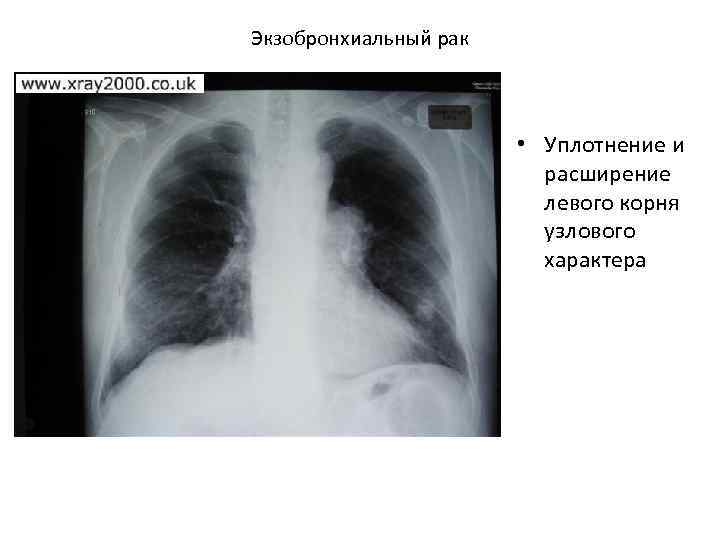 Экзобронхиальный рак • Уплотнение и расширение левого корня узлового характера 