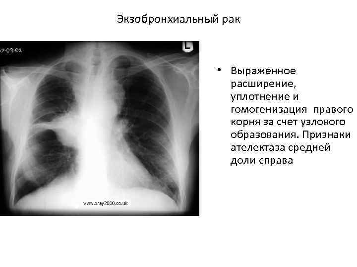 Экзобронхиальный рак • Выраженное расширение, уплотнение и гомогенизация правого корня за счет узлового образования.