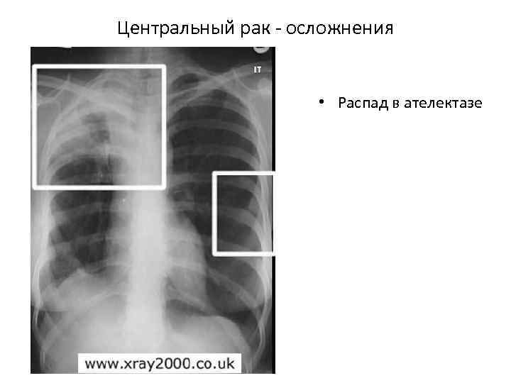 Центральный рак - осложнения • Распад в ателектазе 