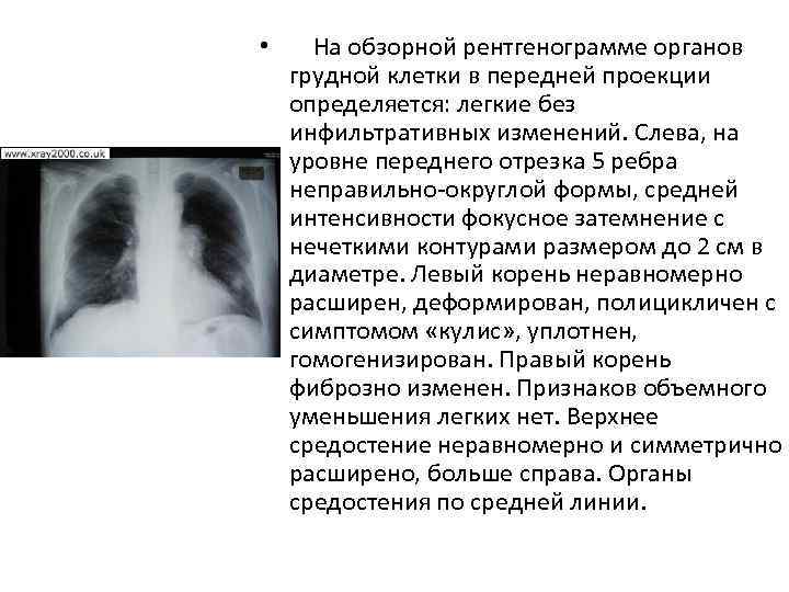 План описания рентгенограммы легких