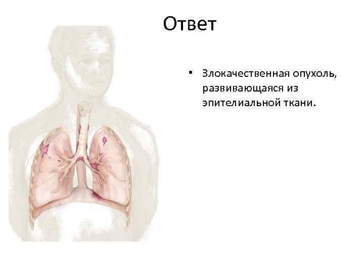 Ответ • Злокачественная опухоль, развивающаяся из эпителиальной ткани. 