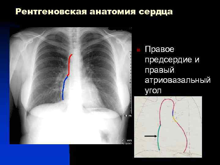 Рентгеновская анатомия сердца n Правое предсердие и правый атриовазальный угол 