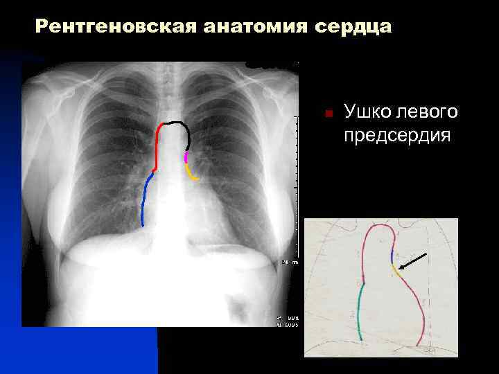 Рентгеновская анатомия сердца n Ушко левого предсердия 