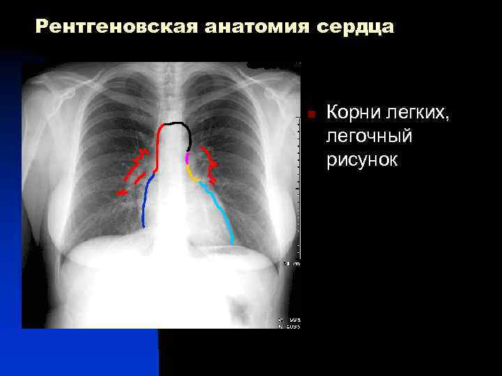 Рентгеновская анатомия сердца n Корни легких, легочный рисунок 