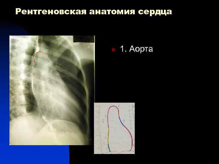 Рентгеновская анатомия сердца 1 n 3 5 7 1. Аорта 