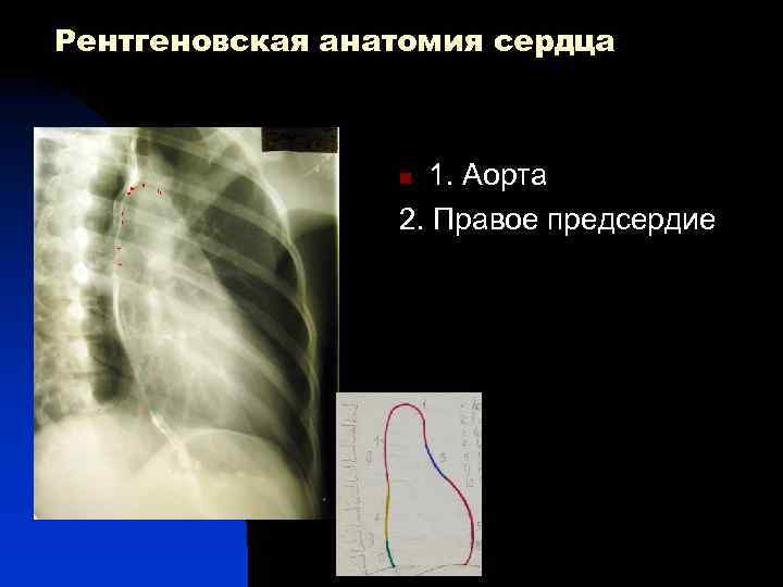 Рентгеновская анатомия сердца 1 1. Аорта 2. Правое предсердие n 3 5 7 